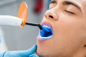 Professionelles Zähne Bleaching beim Zahnarzt mit Zahnzusatzversicherung sparen