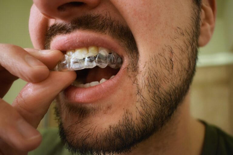 Man putting in an invisible aligner