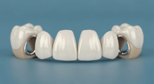 Zahnbrücke aus Keramik und Metall auf blauem Hintergrund