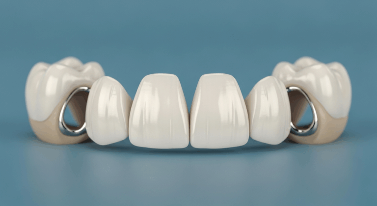 Zahnbrücke aus Keramik und Metall auf blauem Hintergrund