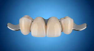 Zahnbrücke mit Metallflügeln auf blauem Hintergrund