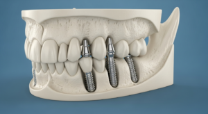 Zahnimplantate im Unterkiefermodell dargestellt