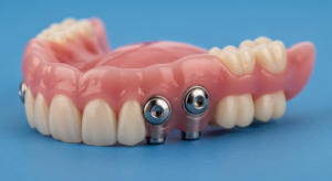 Zahnprothese mit Implantatbefestigung auf blauem Hintergrund