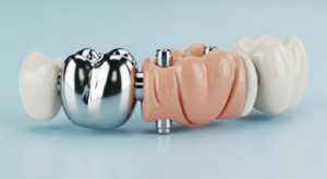 3D-Darstellung von Zahnimplantaten und Kronen