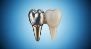 Zahnkrone aus Metall neben natürlichem Zahn