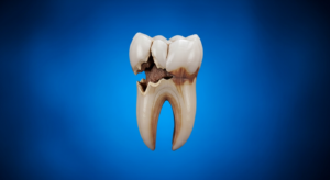 Zahn mit Karies auf blauem Hintergrund