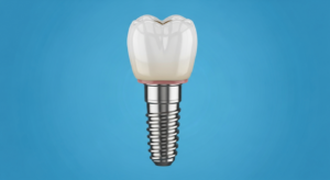 Zahnimplantat aus Metall und Keramik auf blauem Hintergrund