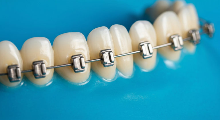 Zähne mit fester Zahnspange auf blauem Hintergrund