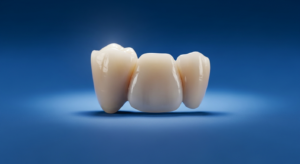 Zahnbrücke aus Keramik auf blauem Hintergrund