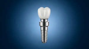 Zahnimplantat aus Metall und Keramik auf blauem Hintergrund