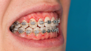 Nahaufnahme von Zähnen mit Zahnspange und gereiztem Zahnfleisch