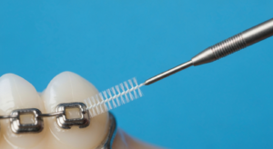 Zahnspange mit Interdentalbürste zur Reinigung