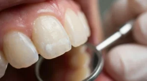 Zahnarzt untersucht Zähne mit Spiegel