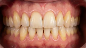 Nahaufnahme menschlicher Zähne und Zahnfleisch